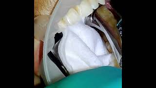 Erupted Third Molar Removal with Forceps [upl. by Ahsinut386]