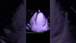 Diagnosis echocardiography [upl. by Natty949]