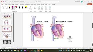 pediatrics cardiology  Mixed lesions  TAPVR amp HLHS [upl. by Ignatz431]