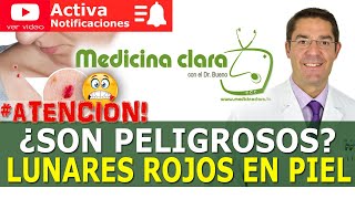 🔴 LUNARES ROJOS PIEL ¿PELIGROSOS 👨‍⚕️ Dejar o EXTIRPAR ¿Qué debemos hacer  Medicina Clara [upl. by Nilac]