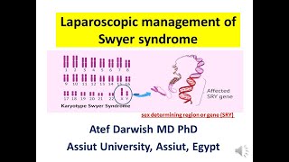 Laparoscopic management of Swyer syndrome [upl. by Andriette594]