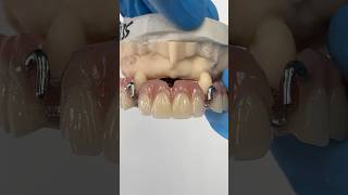 Clasping to the Canines EnvisiontecMain envisiontec lsk121shorts dentist teeth [upl. by Handal722]