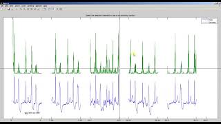 ECGkit  Template matching for QRS correction [upl. by Acinet]