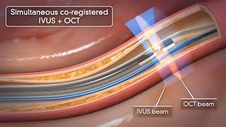 Novasight Hybrid System  Conavi Medical [upl. by Aicat]