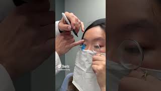 Fitting A Scleral Lens With Eyeprint Pro keratoconus eyedoctor dryeyes contactlenses [upl. by Viviane41]