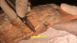 Forearm ExtensorAnatomical SnuffboxHand Dissection  Sanjoy Sanyal [upl. by Eniluj]