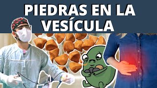 PIEDRAS EN LA VESÍCULA Colelitiasis  ¿POR QUÉ SALEN SÍNTOMAS TRATAMIENTO [upl. by Jary423]