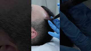 Hair Loss Treatment  RESULTS [upl. by Irap]