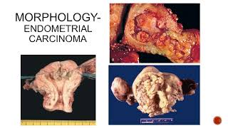 Diseases of the Vulva Vagina Cervix Uterus Part 2 [upl. by Herbst]