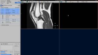 Clinical applications video  Ingenia Knee imaging [upl. by Aleinad]