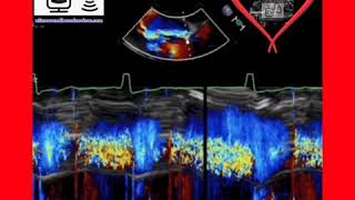 Severe Aortic Regurgitation [upl. by Madora]