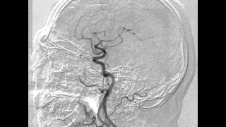 Carotid cavernous fistula angiogram [upl. by Dorr665]