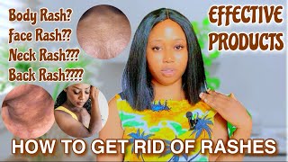 HOW TO GET RID OF RASHES Face Rashes Back Rashes EFFECTIVE PRODUCTS THAT GETS RID OF RASHES [upl. by Tecu144]