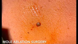 Scarless Mole Removal Using Radiofrequency Ablation [upl. by Oehsen884]