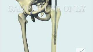 Femoral Fracture Fixation Surgery Intramedullary Nail [upl. by Llehcram]