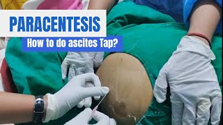 Paracentesis Procedure Ascites Tap in detail [upl. by Intyre]