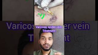 Varicose Vein Treatment shorts pna1 [upl. by Meekah133]