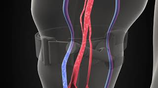 3D illustration of a tourniquet stopping blood flow [upl. by Whang]