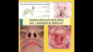 NASOALVEOLAR MOLDING 30 YEARS IN EVOLUTION [upl. by Laszlo839]