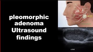 pleomorphic adenoma ultrasound findings [upl. by Jehias480]