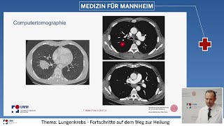 Vom Röntgenbild bis zur Therapie  moderne Diagnostik bei Lungenkrebs [upl. by Lanny]