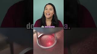 Tratar ou não tratar o melasma estética pele melasma [upl. by Darrin]