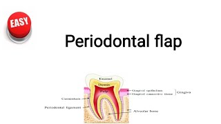 periodontal flap [upl. by Ecirtnom]