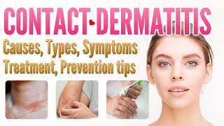 Contact Dermatitis Causes Types Symptoms Treatment Prevention  contact eczema [upl. by Aloisia]