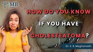 How Do You Know if You Have Cholesteatoma Dr K R Meghanadh Medyblog [upl. by Aneliram157]