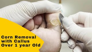 Corn Removal with Callus  Removing Hard Foot Callus Part 2  Foot Care Callus Podiatry [upl. by Gensmer]