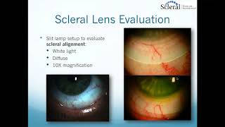 Scleral Lenses Basic to Advanced Troubleshooting [upl. by Arber633]