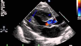 How to do pediatric echocardiography study [upl. by Giraud]