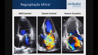 Novas Recomendacoes de ASE para Regurgitacao de Valve Nativa [upl. by Chobot]