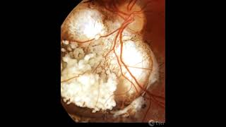 Stereophotography of a retinoblastoma after treatment Courtesy of marback1972 [upl. by Ainezey969]