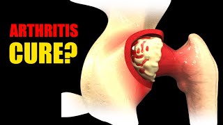 Arthritis Youre Treating It Wrong See How to Actually Repair Cartilage [upl. by Nikolaus580]