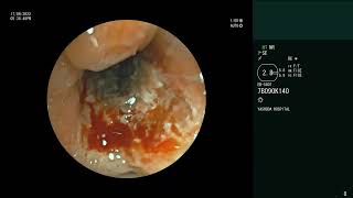 Pulmonary Mucormycosis  Bronchoscopy  Biopsy [upl. by Lemej490]