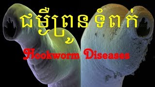 Hookworm diseases ជម្ងឺព្រូនទំពក់ [upl. by Alarice677]