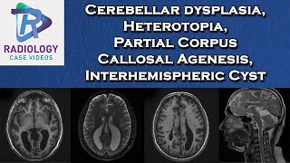 Cerebellar dysplasia Heterotopia Partial Corpus Callosal Agenesis Interhemispheric Cyst [upl. by O'Gowan]