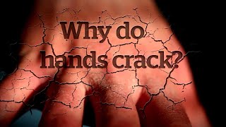 Hands cracking from COVID19 washing Heres what to do [upl. by Kristy598]