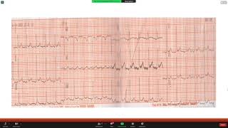 Atrial Tachycardia EP STUDY and Ablation Dr Lamyaa Allam [upl. by Cassie]