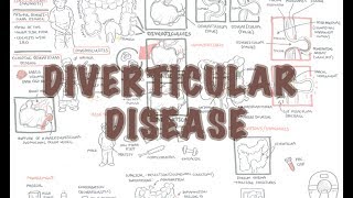 Diverticular Disease diverticulitis  Overview [upl. by Bonney]