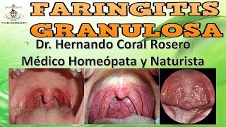 FARINGITIS GRANULOSA  INFLAMACIÓN DE LA FARINGE CON PERI ADENITIS COLORACIÓN ROJIZA [upl. by Poppas]