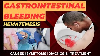 Upper Gastrointestinal Bleeding  Upper GI Bleeding  GI Bleeding  Hematemesis [upl. by Spiro]