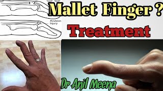 mallet finger treatment  mallet finger treatment at home  mallet finger exercises  in hindi [upl. by Lissner945]