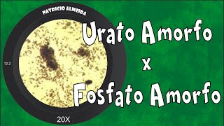 Cristais de urato amorfo e fosfato amorfo na urina [upl. by Toblat]