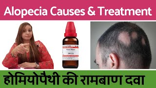 Alopecia Areata treatment  alopecia ka ilaj  alopecia areata homeopathic treatment in hindi [upl. by Eustatius]