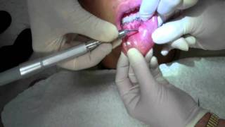 Mucoclele Removal with Laser  Cosmetic Dentist Palmdale CA [upl. by Celestia]