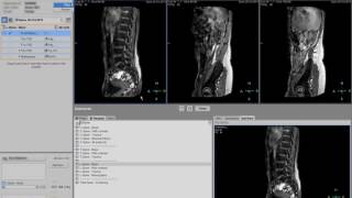 Clinical applications video  Ingenia Spine imaging [upl. by Ydnas]