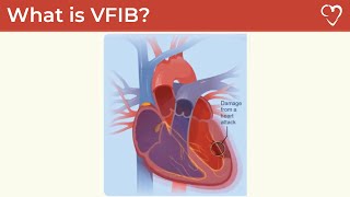 What is Ventricular Fibrillation VFIB [upl. by Eicart]