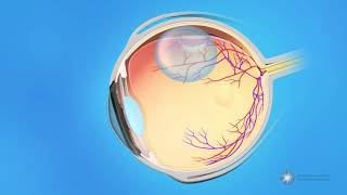 Pneumatic Retinopexy for Detached Retina [upl. by Teerpnam]